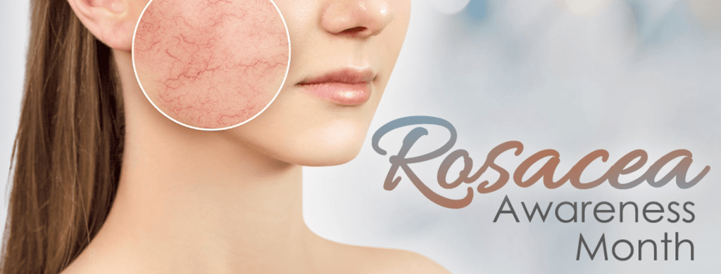 Rosacea Skin 101: What You Can Do Naturally Through A Holistic Approach to Control the Symptoms
