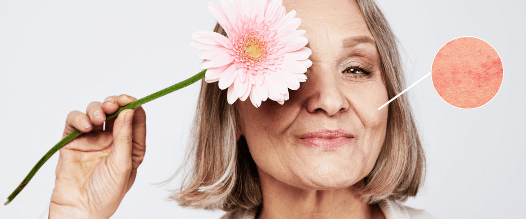 What To Expect About Rosacea During Menopause
